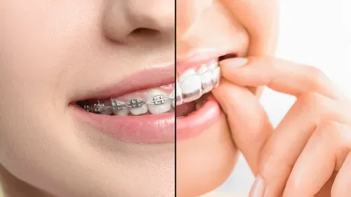 Treatment options for a gap between teeth including braces clear aligners and bonding