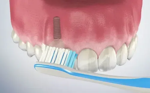Dental implant warning signs and peri implant health assessment