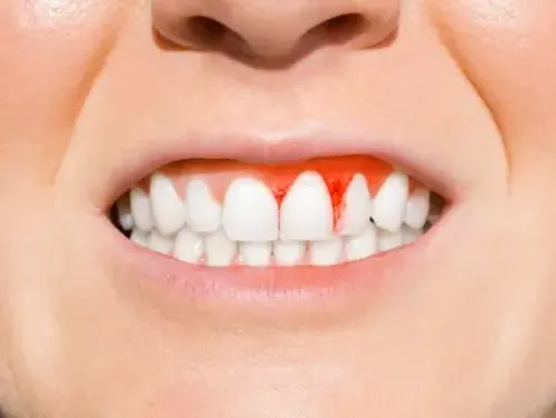 Receding gums and exposed tooth root treatment in Hyderabad at Dr.Sri Sushma Dental Clinic Anandbagh
