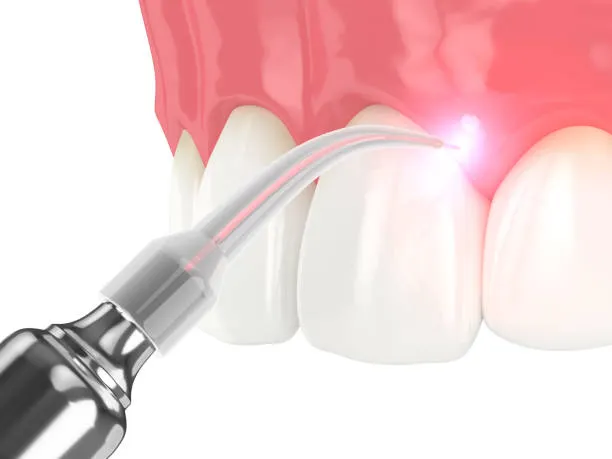 Gum Treatment in Anandbagh, Hyderabad