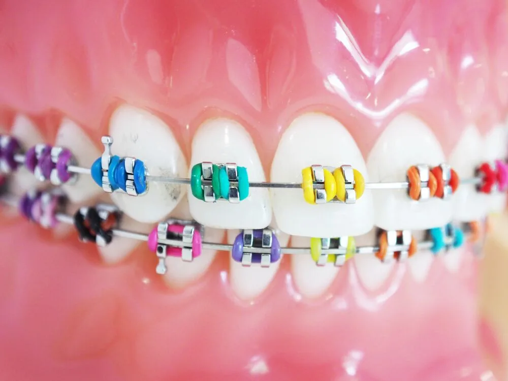 Orthodontic Treatment in Anandbagh, Hyderabad