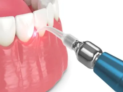 Laser Dentistry in Anandbagh, Hyderabad