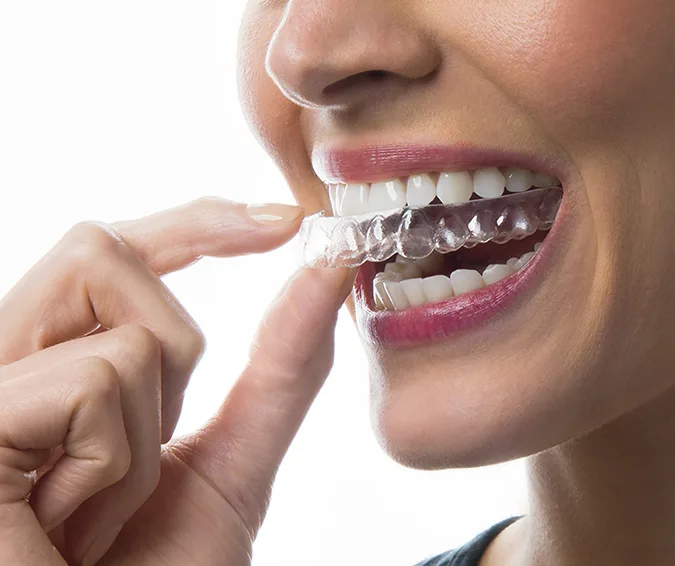 Clear Aligners in Anandbagh, Hyderabad