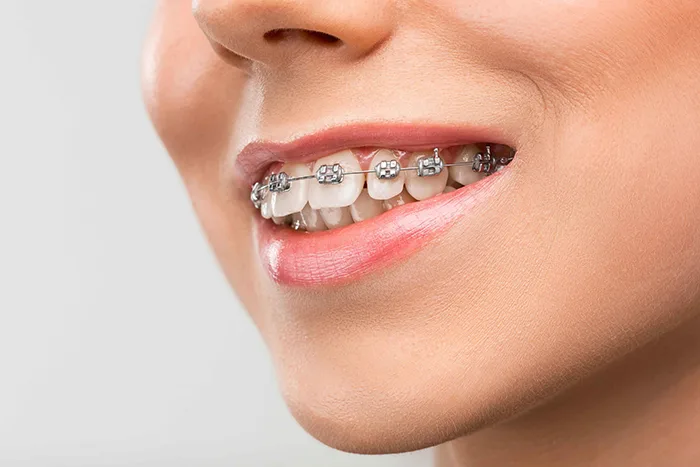 Dental Braces in Anandbagh, Hyderabad