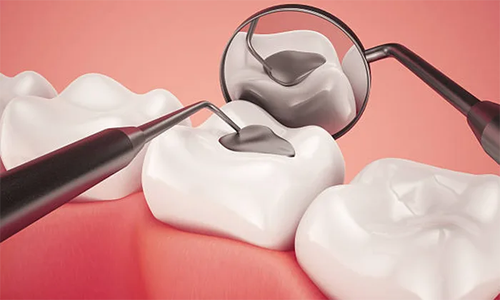Dental Fillings in Anandbagh, Hyderabad
