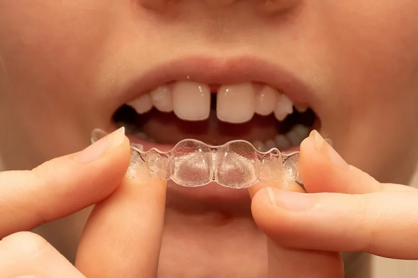 Teeth Gap Treatment in Anandbagh, Hyderabad