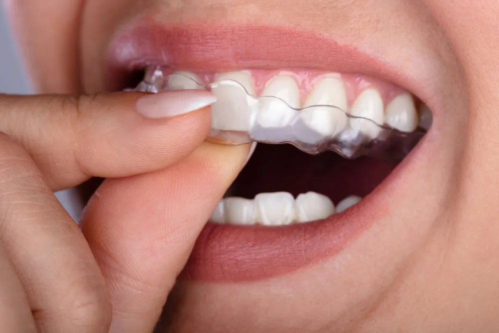 Clear Aligners in Hyderabad at Dr.Sri Sushma Multispeciality Dental Clinic, Anandbagh Hyderabad