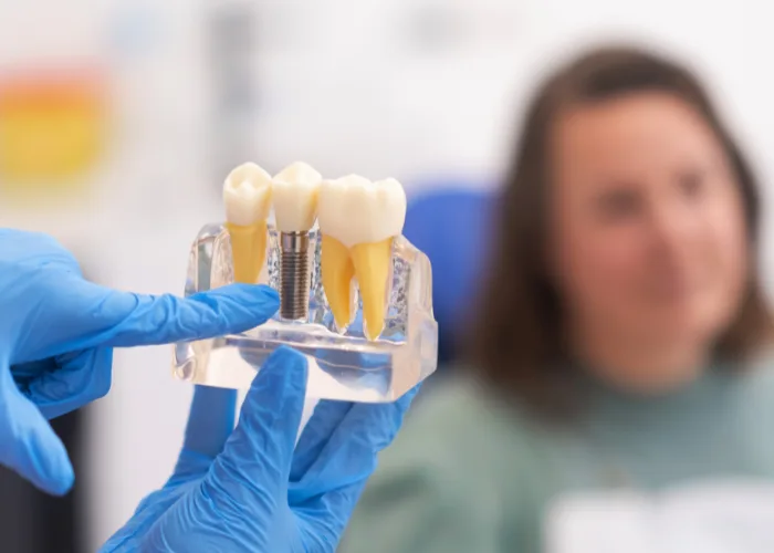 Dental Crowns & Bridges in Hyderabad at Dr.Sri Sushma Multispeciality Dental Clinic, Anandbagh Hyderabad