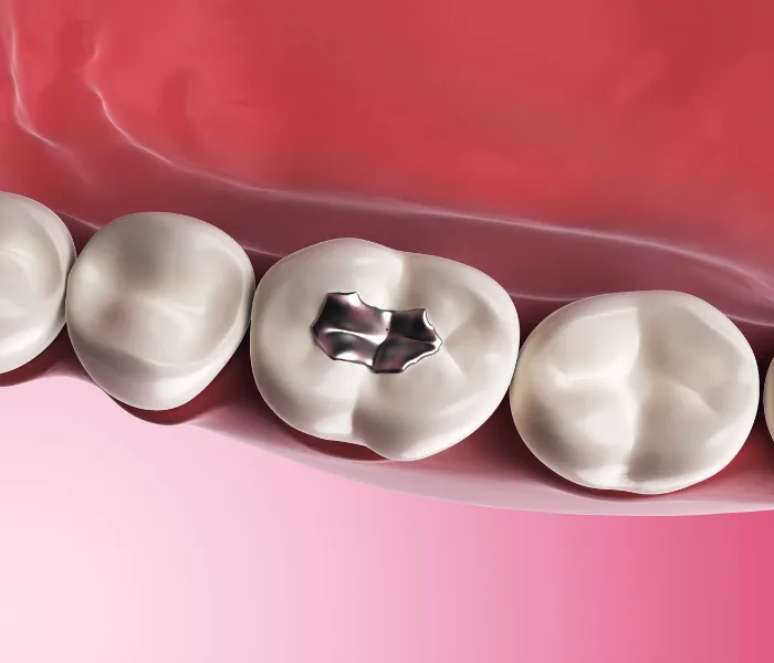 Dental Fillings in Hyderabad at Dr.Sri Sushma Multispeciality Dental Clinic, Anandbagh Hyderabad