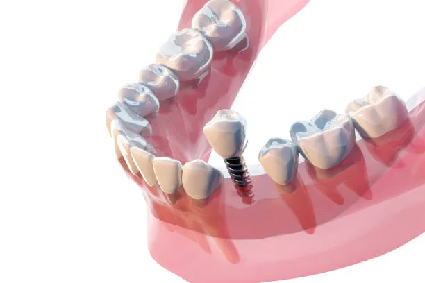 Dental Implants in Hyderabad at Dr.Sri Sushma Multispeciality Dental Clinic, Anandbagh Hyderabad
