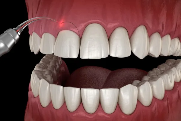 Laser Dental Treatment in Hyderabad at Dr.Sri Sushma Multispeciality Dental Clinic, Anandbagh Hyderabad