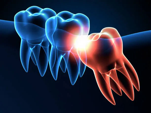 Wisdom Tooth Removal in Hyderabad at Dr.Sri Sushma Multispeciality Dental Clinic, Anandbagh Hyderabad