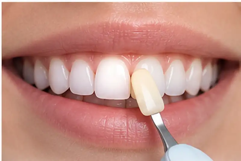 Dental Bonding in Anandbagh, Hyderabad