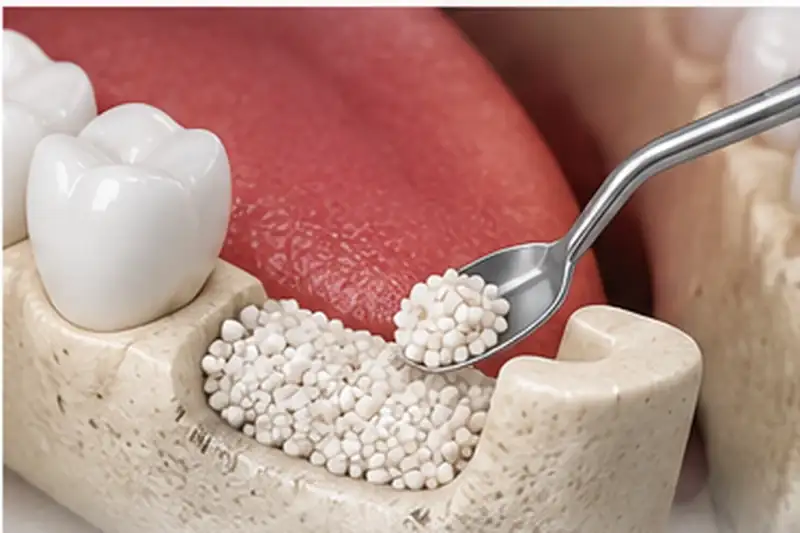 Dental Bone Grafting in Anandbagh, Hyderabad