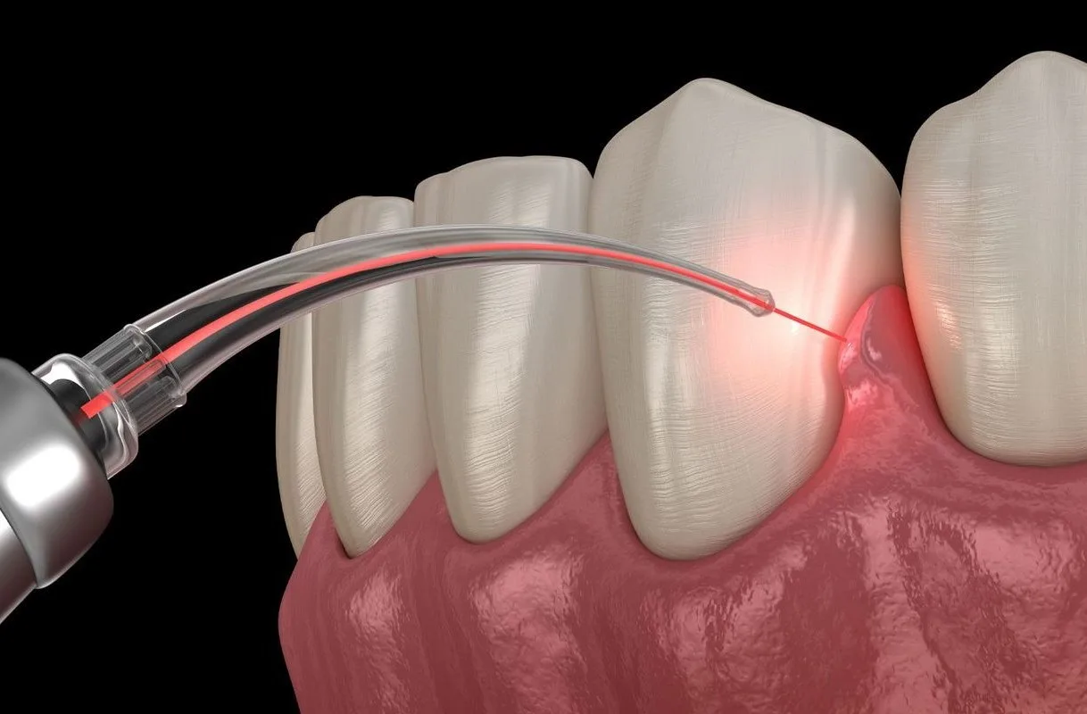 Gum Disease Treatment in Hyderabad at Dr.Sri Sushma Multispeciality Dental Clinic, Anandbagh Hyderabad