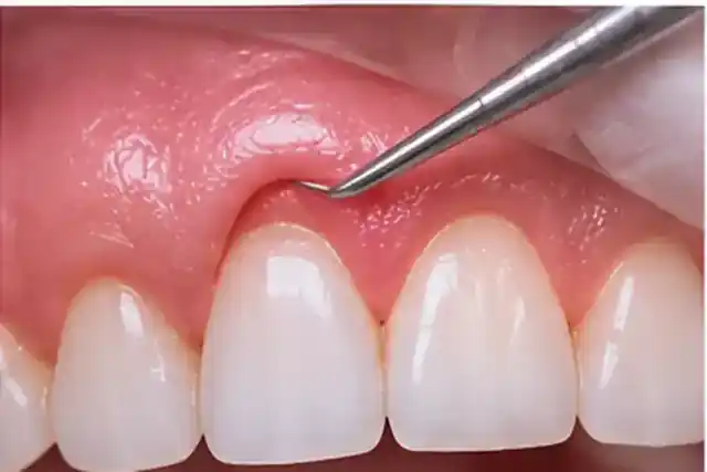 Gum Surgery in Anandbagh, Hyderabad