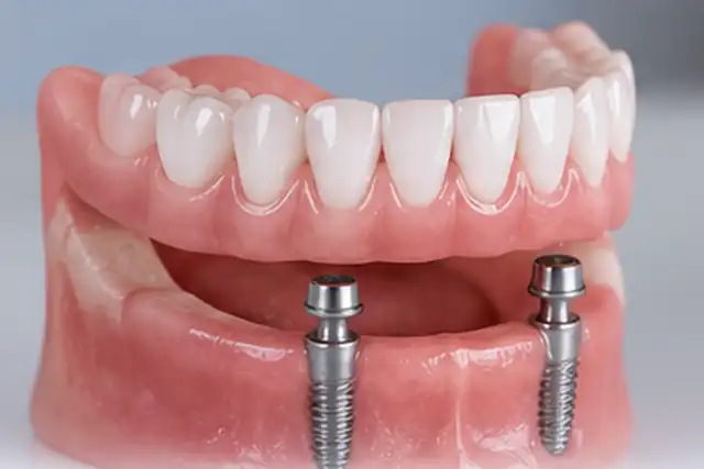 Implant-Supported Dentures in Anandbagh, Hyderabad