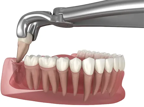 Wisdom Tooth Removal in Anandbagh, Hyderabad